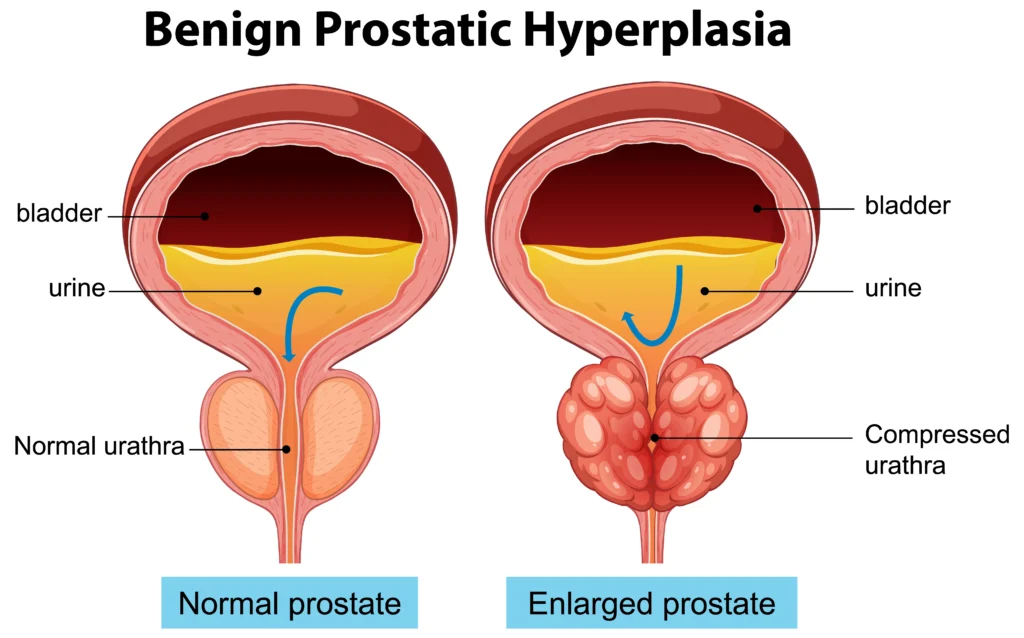 Best Uro Oncologist in Medinipur, Prostate Cancer vs. BPH