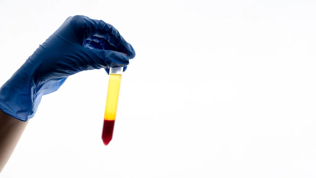 Best Uro Oncologist in Medinipur, Blood in Urine (Haematuria)